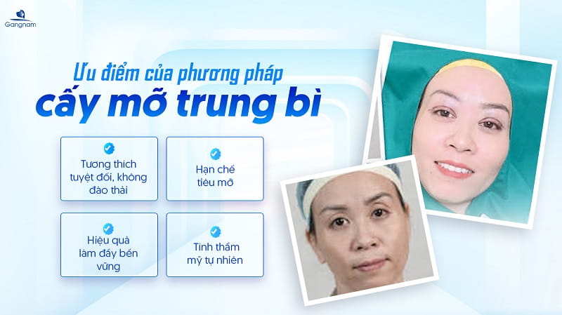 Cấy mỡ trung bì mí mắt - Mang lại vẻ rạng rỡ, trẻ tung tự nhiên 6 Cấy mỡ trung bì mí mắt