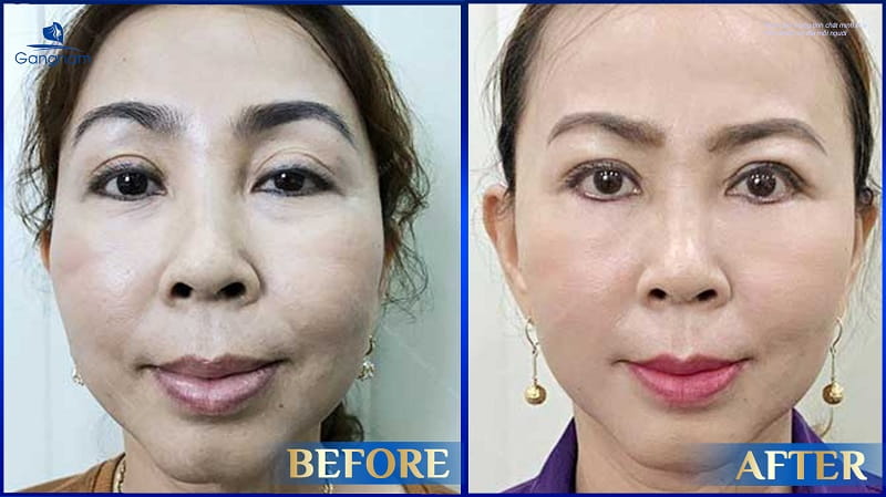 Chỉnh 2 mắt không đều - Khắc phục khuyết điểm mắt bên to bên nhỏ 8 Chỉnh 2 mắt không đều