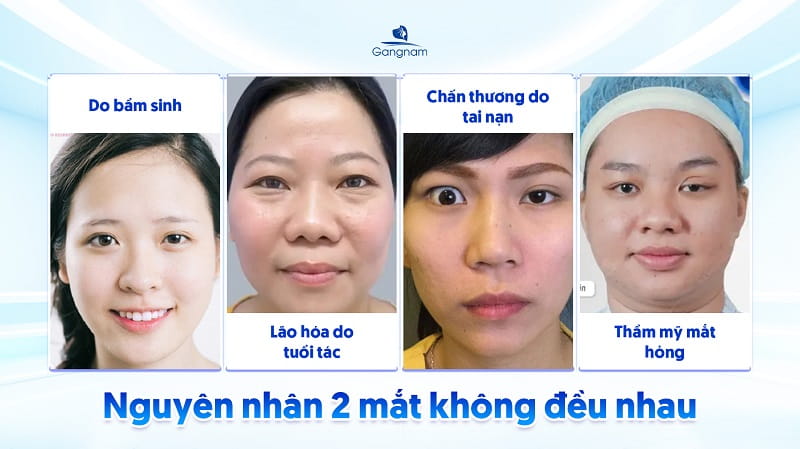 Chỉnh 2 mắt không đều - Khắc phục khuyết điểm mắt bên to bên nhỏ 6 Chỉnh 2 mắt không đều