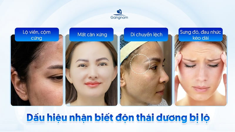 Độn thái dương có bị lộ không? 7 Độn thái dương có bị lộ không?