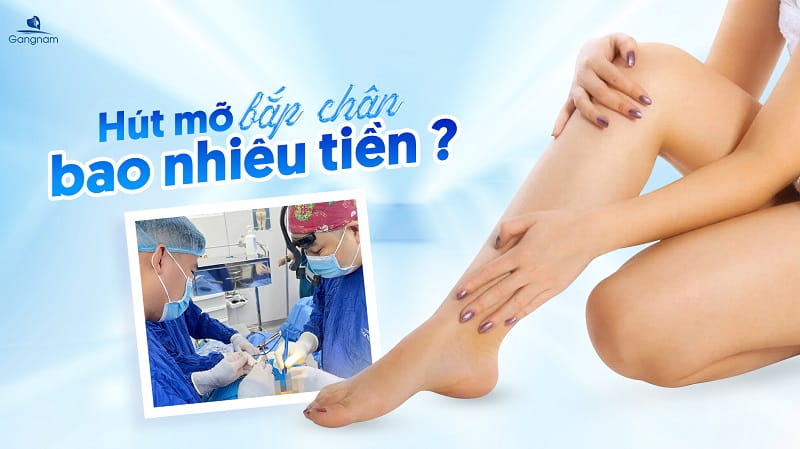 Hút mỡ bắp chân bao nhiêu tiền? 5 Hút mỡ bắp chân bao nhiêu tiền?