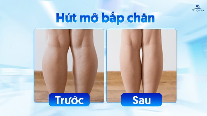 Hút mỡ bắp chân bao nhiêu tiền? 7 Hút mỡ bắp chân bao nhiêu tiền?
