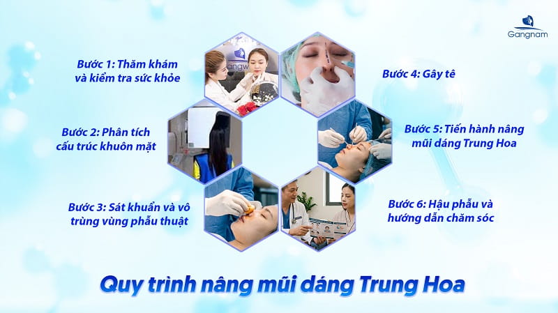 Nâng mũi dáng Trung Hoa - Xu hướng thẩm mỹ của giới trẻ 8 Nâng mũi dáng Trung Hoa