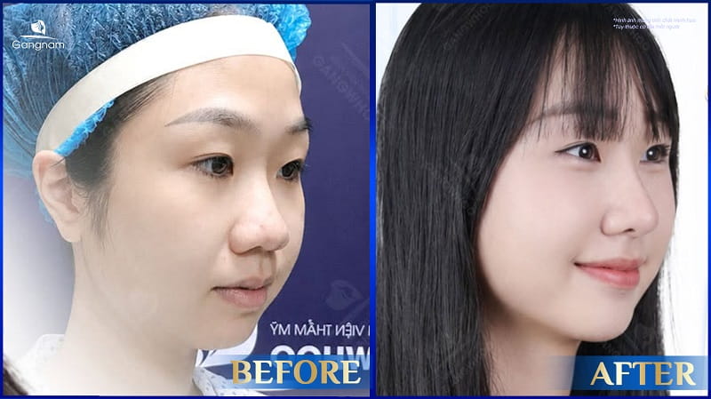 Nâng mũi dáng Trung Hoa - Xu hướng thẩm mỹ của giới trẻ 9 Nâng mũi dáng Trung Hoa