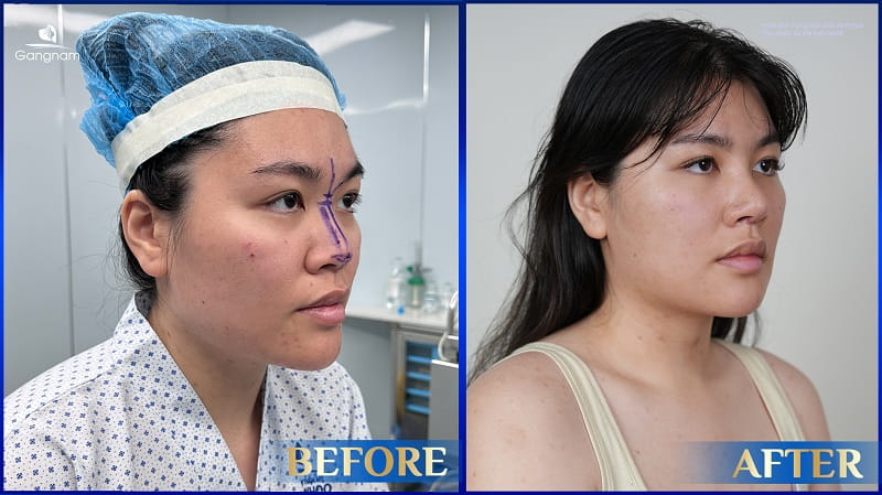 Nâng mũi dựng trụ là gì? Giá bao nhiêu? 10 Nâng mũi dựng trụ là gì?