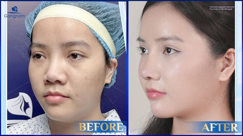 Nâng mũi Zose Line - Dáng mũi được thiết kế dành riêng cho GenZ 7 Nâng mũi Zose Line