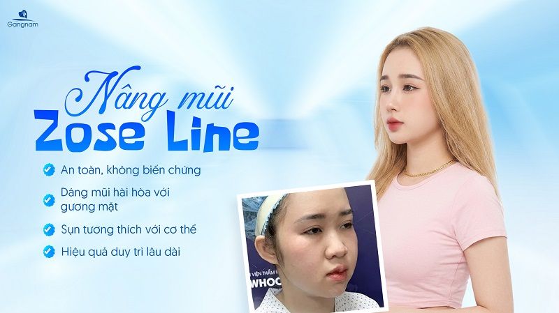 Nâng mũi Zose Line - Dáng mũi được thiết kế dành riêng cho GenZ 6 Nâng mũi Zose Line