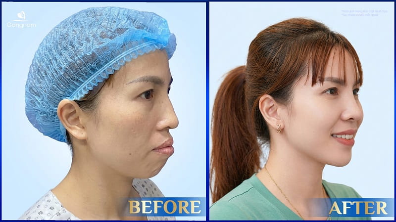 Phẫu thuật chỉnh hàm móm ở đâu an toàn, hiệu quả? 6 Phẫu thuật chỉnh hàm móm