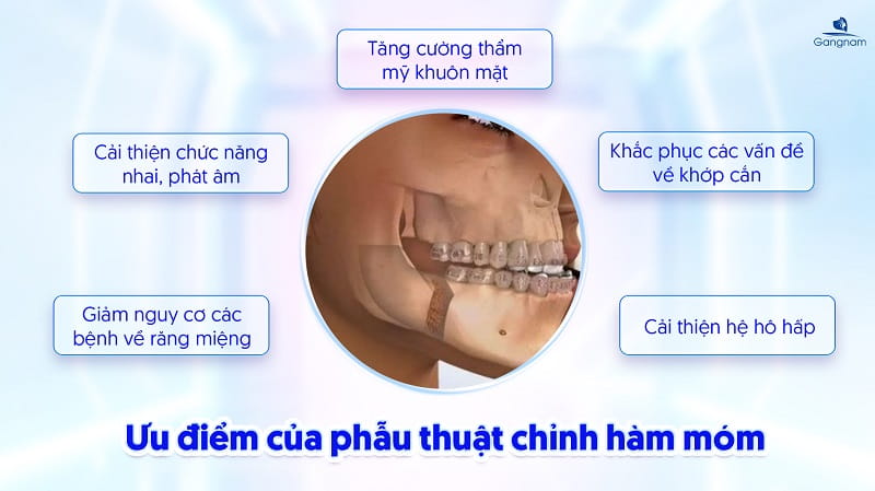 Phẫu thuật chỉnh hàm móm ở đâu an toàn, hiệu quả? 5 Phẫu thuật chỉnh hàm móm