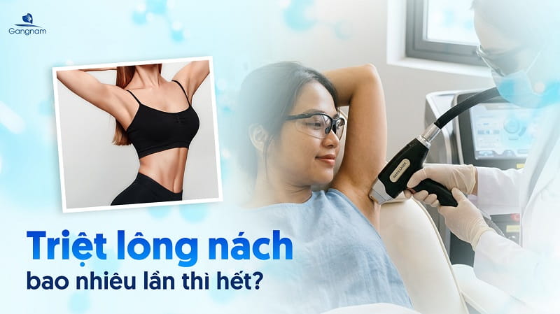 Triệt lông nách bao nhiêu lần thì hết? 4 Triệt lông nách bao nhiêu lần thì hết?