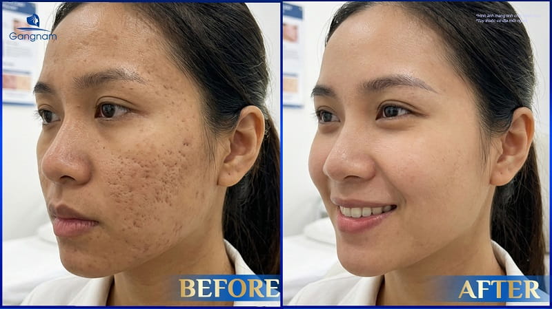 5 cách trị sẹo lõm bằng rau má hiệu quả 8 Cách trị sẹo lõm bằng rau má