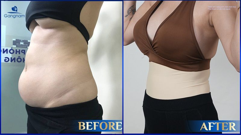 Hút mỡ bị tụ dịch có nguy hiểm không? 6 Hút mỡ bị tụ dịch