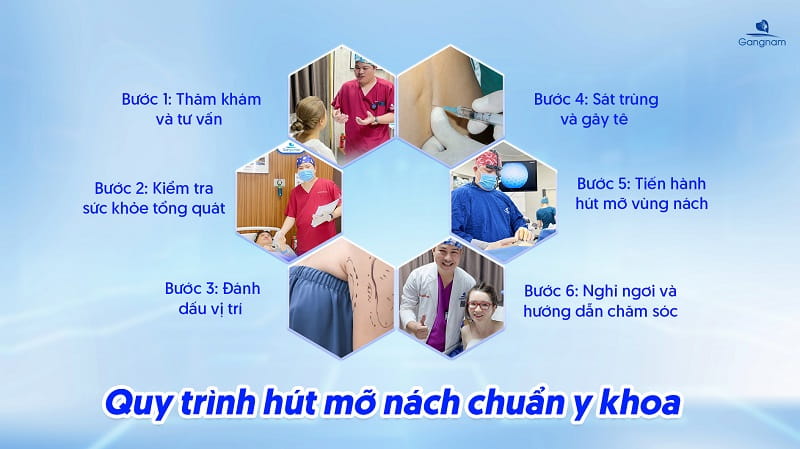Hút mỡ nách là gì? Tìm hiểu cùng chuyên gia 7 Hút mỡ nách