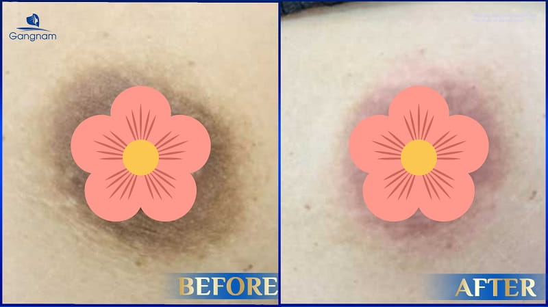 Làm hồng nhũ hoa bằng Laser - Giải pháp an toàn và hiệu quả 8 Làm hồng nhũ hoa bằng Laser