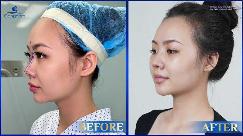 Phụ nữ mang thai có nâng mũi được không? 10 Phụ nữ mang thai có nâng mũi được không?