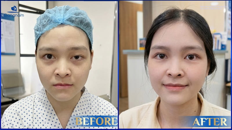 Mắt sụp mí có nên nhấn mí không? 9 Mắt sụp mí có nên nhấn mí không?