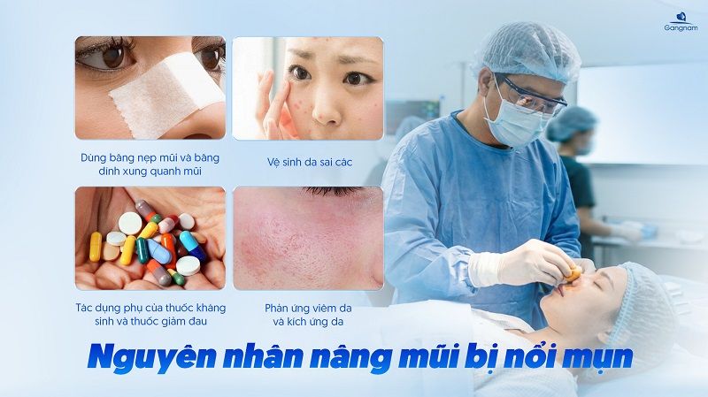 Nâng mũi bị nổi mụn có nguy hiểm không? 7 Nâng mũi bị nổi mụn