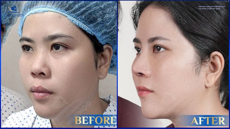 Nâng mũi bị nổi mụn có nguy hiểm không? 10 Nâng mũi bị nổi mụn