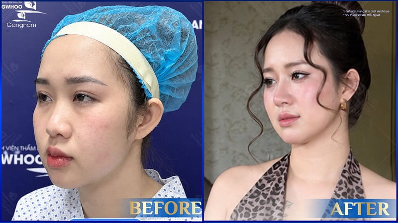 Mũi cao là gì? Tướng mũi cao có tốt không? 10 Nâng mũi có thay đổi khuôn mặt không?