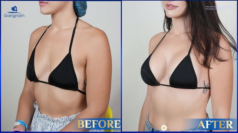 Nâng ngực túi Sebbin - Kiến tạo vòng 1 căng tròn, quyến rũ 8 Nâng ngực túi Sebbin