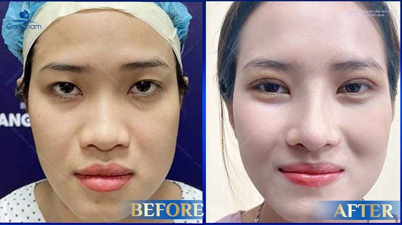 Nhấn mí vi điểm giữ được bao lâu? 9 Nhấn mí vi điểm