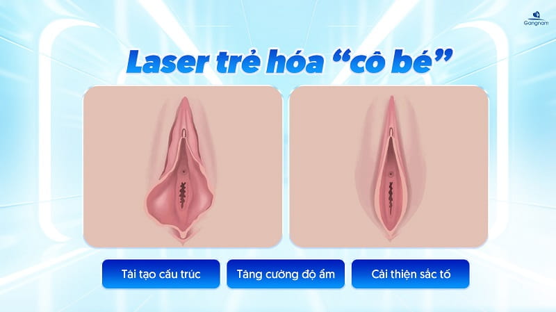 Trẻ hóa vùng kín bằng Laser - Giải pháp làm đẹp cô bé an toàn, hiệu quả 6 Trẻ hóa vùng kín