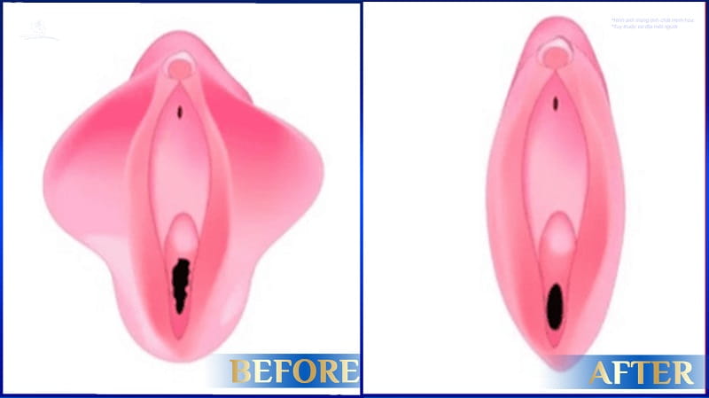 Trẻ hóa vùng kín bằng Laser - Giải pháp làm đẹp cô bé an toàn, hiệu quả 8 Trẻ hóa vùng kín