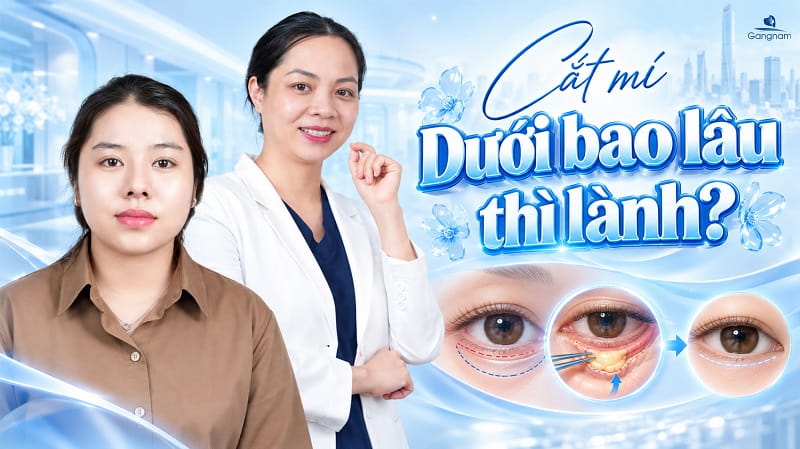Cắt mí dưới bao lâu thì lành? Thời gian hồi phục chi tiết 5 Cắt mí dưới bao lâu thì lành?