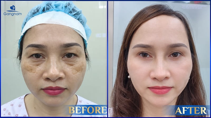Cắt mí dưới bao lâu thì lành? Thời gian hồi phục chi tiết 7 Cắt mí dưới bao lâu thì lành?