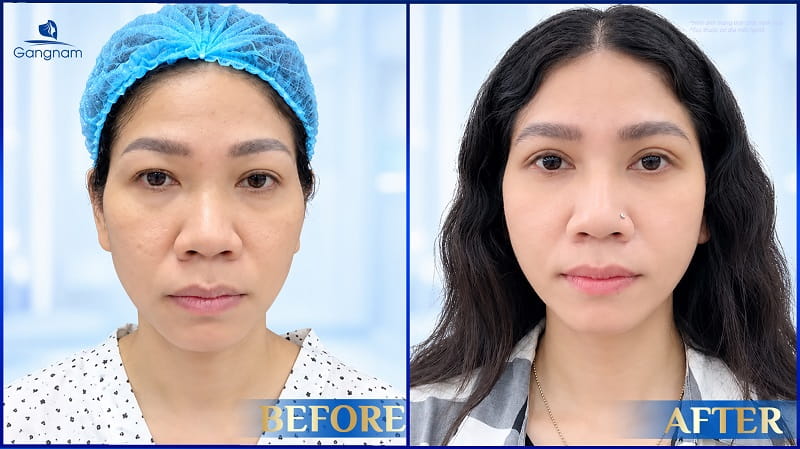 Cắt mí tự nhiên là gì? Ưu điểm và quy trình thực hiện 9 Cắt mí tự nhiên