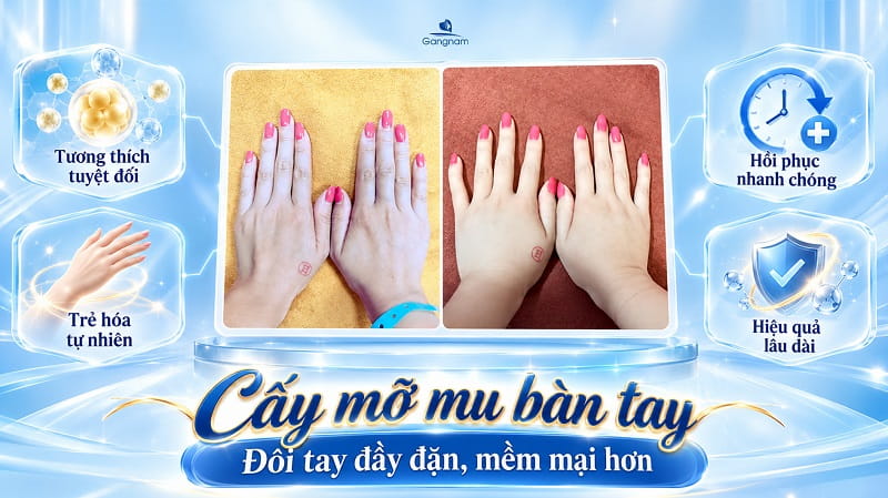 Cấy mỡ bàn tay - Giải pháp trẻ hóa "bàn tay búp măng" an toàn, hiệu quả 6 Cấy mỡ bàn tay