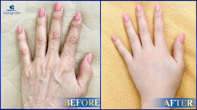 Cấy mỡ bàn tay - Giải pháp trẻ hóa "bàn tay búp măng" an toàn, hiệu quả 8 Cấy mỡ bàn tay