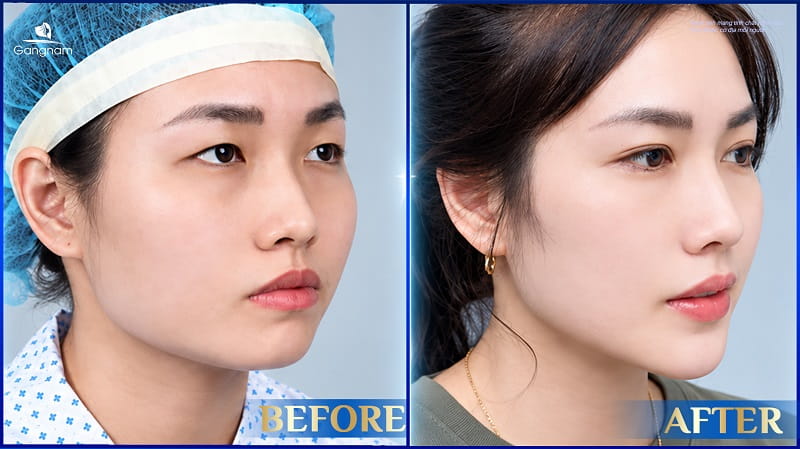 Độn cằm sụn Surgiform - Giải pháp cho dáng cằm V-Line thon gọn, tự nhiên 10 Độn cằm sụn Surgiform