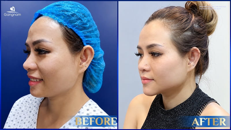 Độn cằm sụn Surgiform - Giải pháp cho dáng cằm V-Line thon gọn, tự nhiên 9 Độn cằm sụn Surgiform