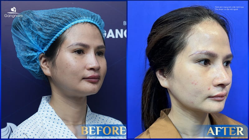 Gọt hàm đeo đai định hình bao lâu? 10 Gọt hàm đeo đai định hình bao lâu?