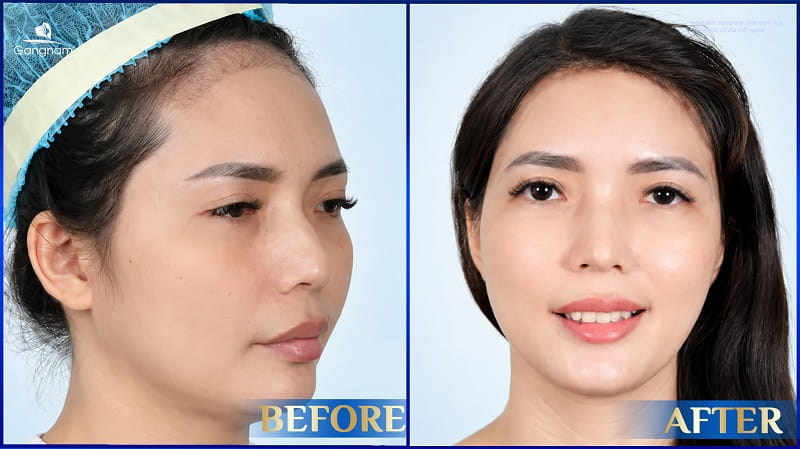 Hạ đường chân tóc là gì? Bí quyết sở hữu khuôn mặt cân đối, tỷ lệ vàng 8 Hạ đường chân tóc