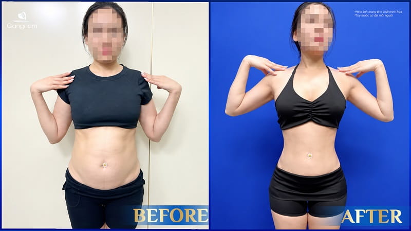 Hút mỡ trả góp: Giải pháp lấy lại vóc dáng thon gọn không lo tài chính 8 Hút mỡ trả góp