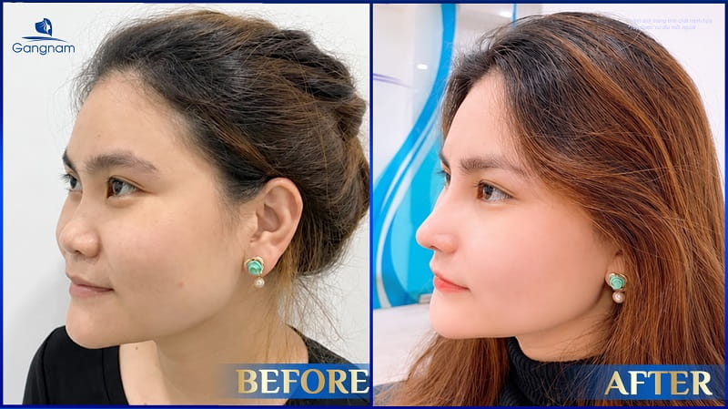 Nâng mũi sụn sườn giá bao nhiêu? Các yếu tố ảnh hưởng đến chi phí thực hiện 9 Nâng mũi sụn sườn giá bao nhiêu?