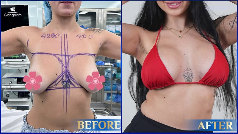 Nâng ngực Tissue Preservation là gì? Giải pháp thẩm mỹ vòng 1 ít xâm lấn, phục hồi nhanh 9 Nâng ngực Tissue Preservation