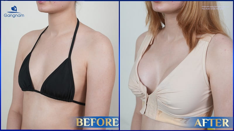 Nâng ngực túi Cereform là gì? Có tốt không? Giá bao nhiêu? 10 Nâng ngực túi Cereform