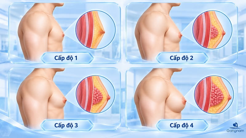Nữ hóa tuyến vú ở nam giới: Nguyên nhân, triệu chứng và giải pháp điều trị dứt điểm 6 Nữ hóa tuyến vú ở nam giới