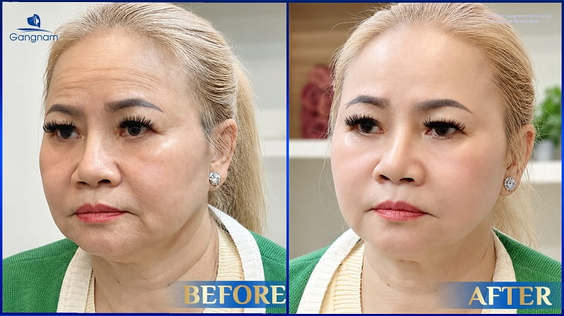 Tiêm Filler rãnh cười giá bao nhiêu? 7 Tiêm Filler rãnh cười giá bao nhiêu?