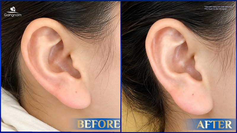 Tiêm tai tài lộc tại thẩm mỹ viện Gangnam: Đổi vận phong thủy, đẹp chuẩn y khoa 8 Tiêm tai tài lộc