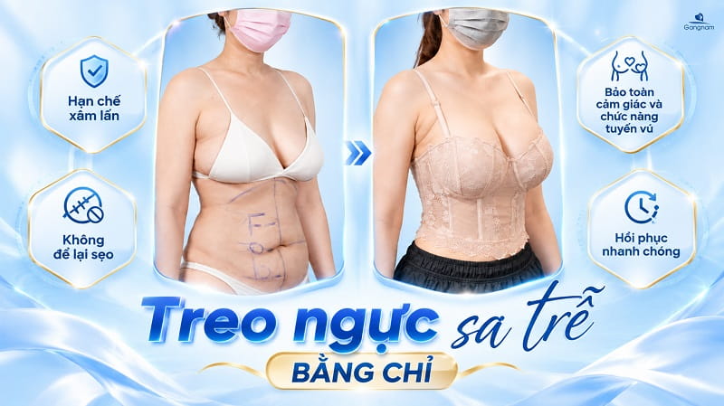 Treo ngực sa trễ bằng chỉ có hiệu quả không? 6 Treo ngực sa trễ bằng chỉ