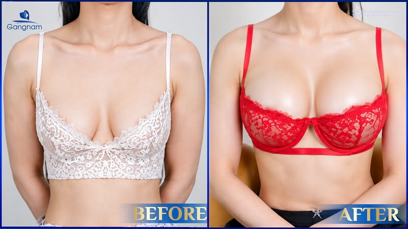 Treo ngực sa trễ bằng chỉ có hiệu quả không? 8 Treo ngực sa trễ bằng chỉ