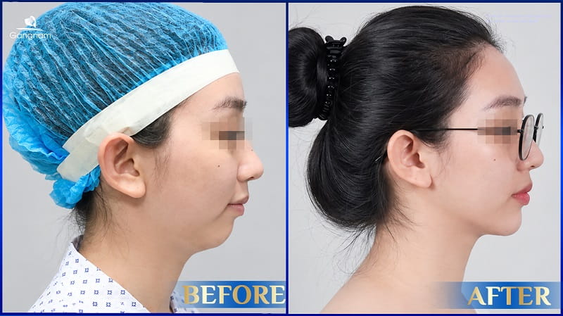 Trượt cằm giá bao nhiêu? Chi phí và những điều cần biết 7 Trượt cằm giá bao nhiêu?